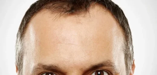 Widow Peak Hairline