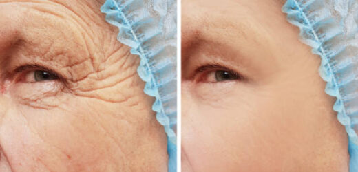Which Wrinkle-Reducing Option Is Best for You?