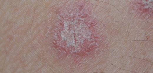 Identifying Skin Growths and Other Skin Problems