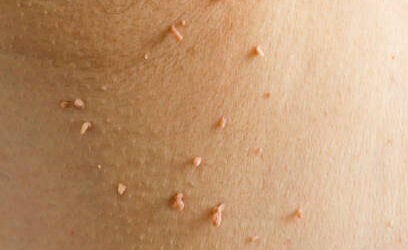 Skin Tags: Symptoms, Causes, and Treatment Options