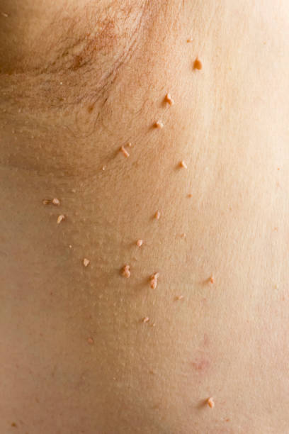 Skin Tags: Symptoms, Causes, and Treatment Options