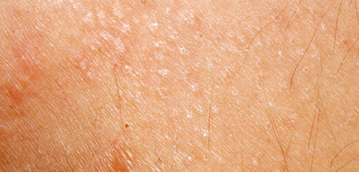 What Is Prurigo Nodularis? Symptoms, Causes, Diagnosis, Treatment, and Prevention